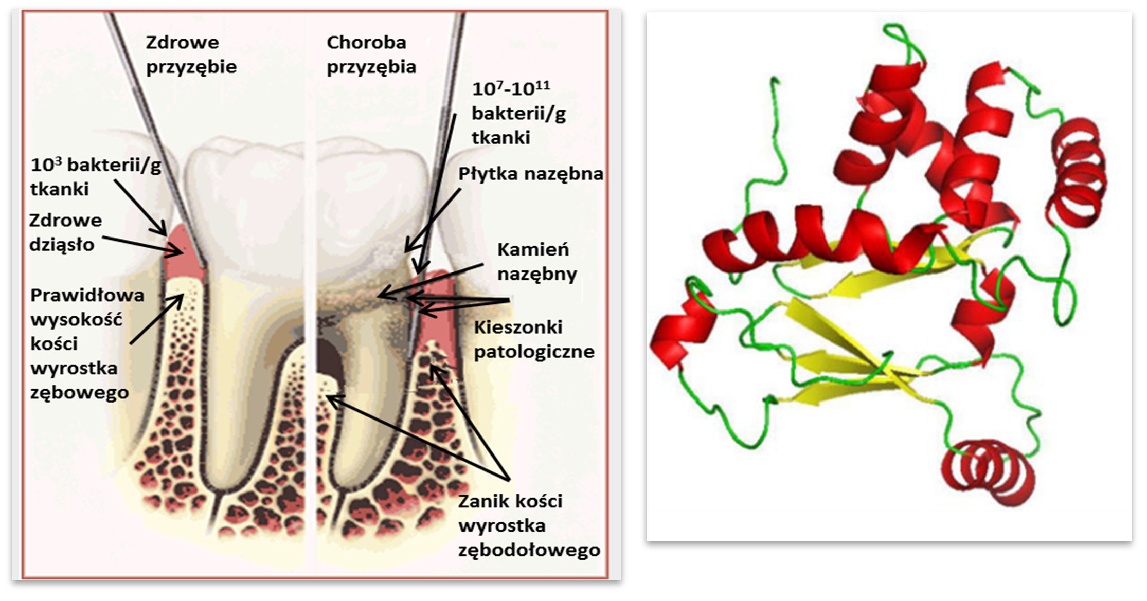 Schemat przedstawiający charakterystyczne objawy chorób przyzębia oraz model struktury białka Fur z bakterii Porphyromonas gingivalis.